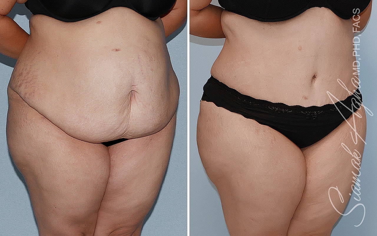 Plus Size Tummy Tuck Before & After
