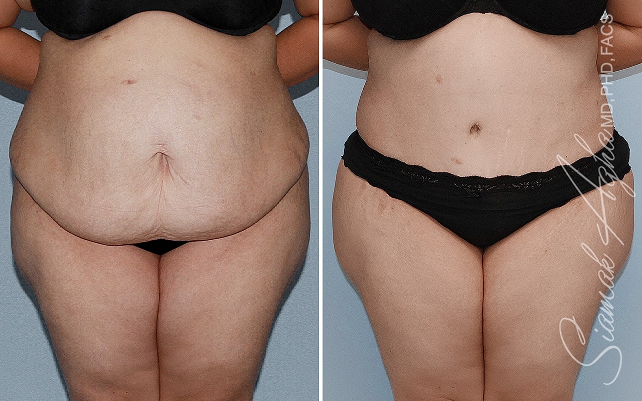 Plus Size Tummy Tuck Before & After