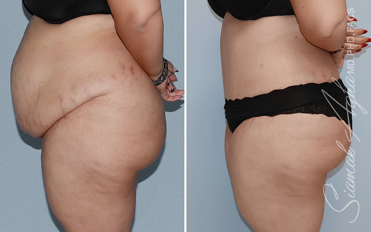 Plus Size Tummy Tuck Before & After