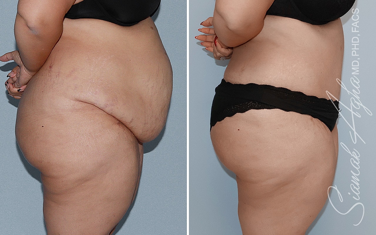 Plus Size Tummy Tuck Before & After