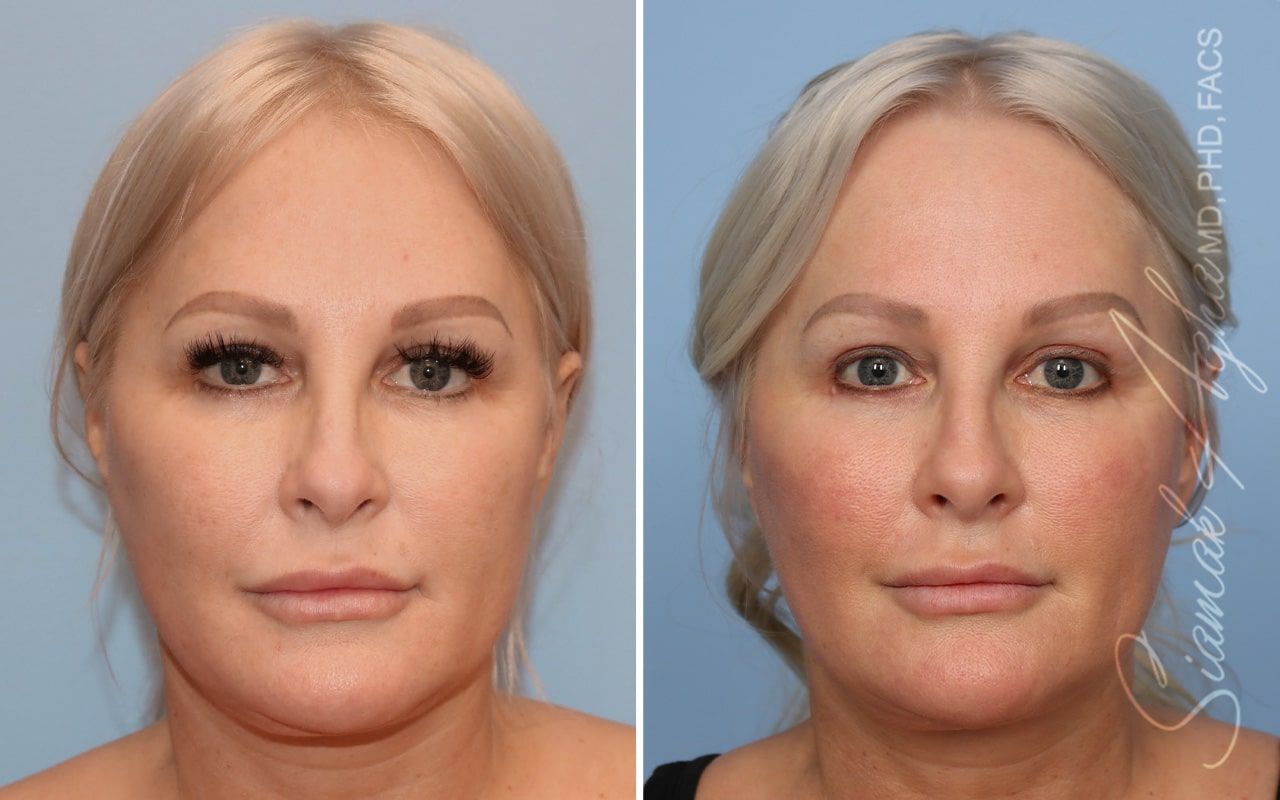 Ellacor Before & After