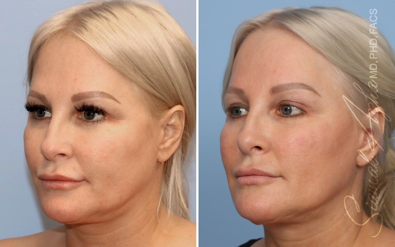 Ellacor Before & After