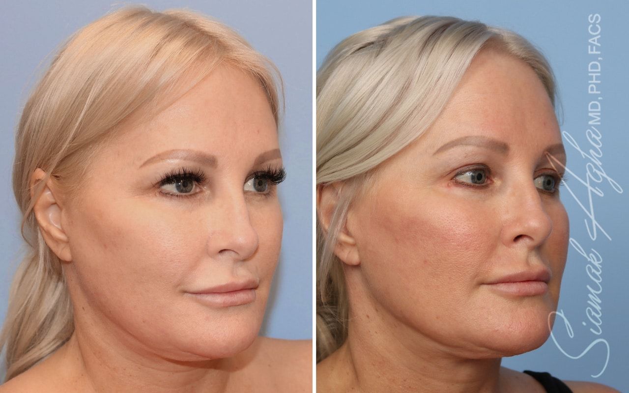 Ellacor Before & After