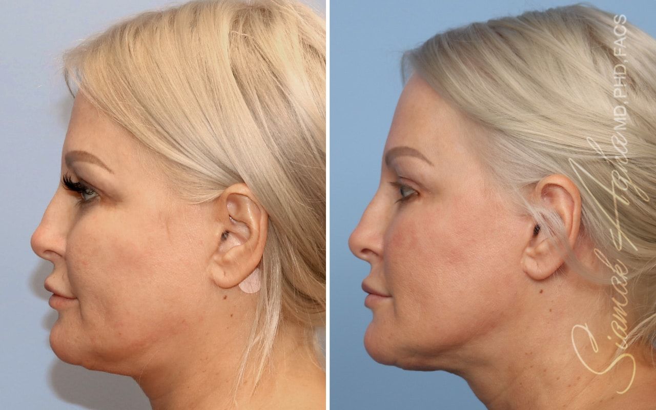 Ellacor Before & After