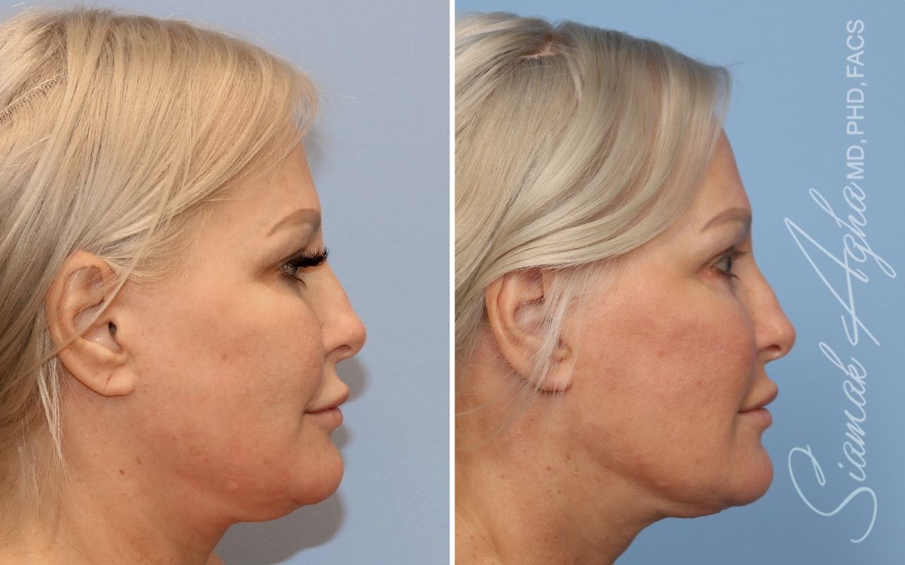 Ellacor Before & After