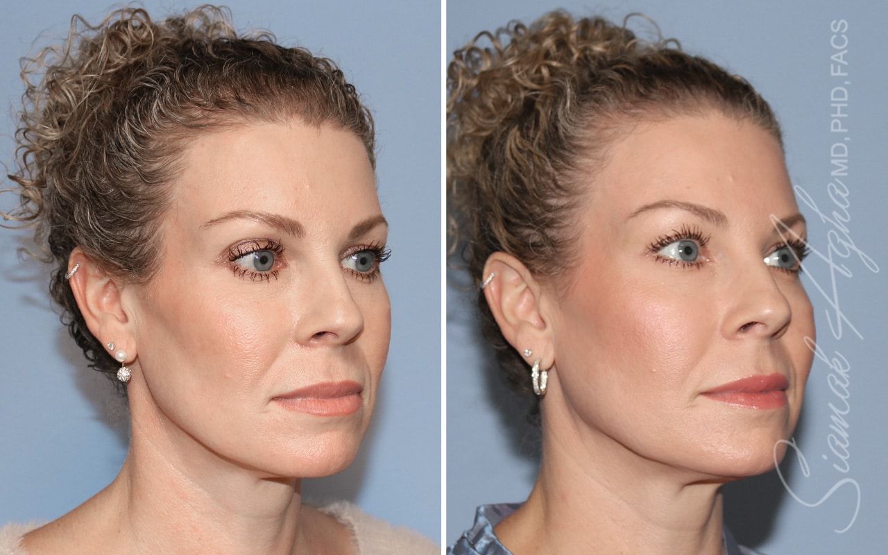 Ellacor Before & After