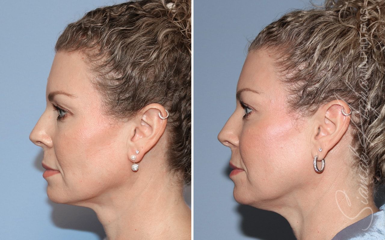 Ellacor Before & After