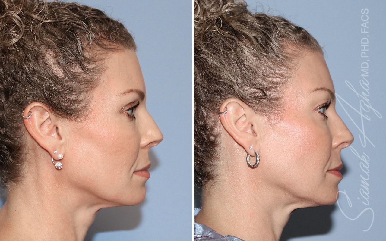 Ellacor Before & After