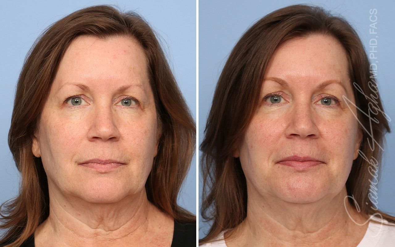 Ellacor Before & After