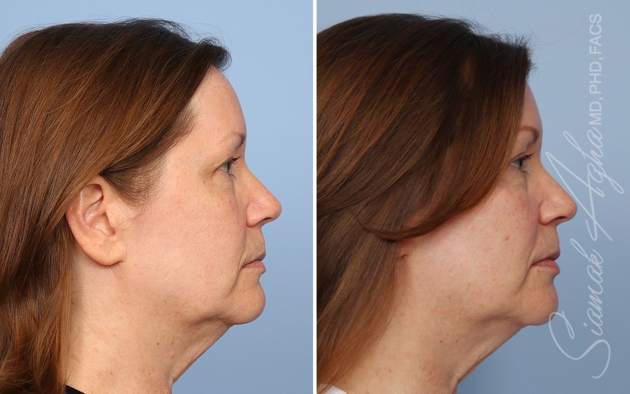 Ellacor Before & After