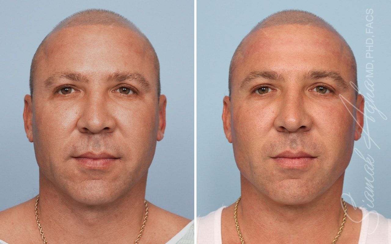 Ellacor Before & After