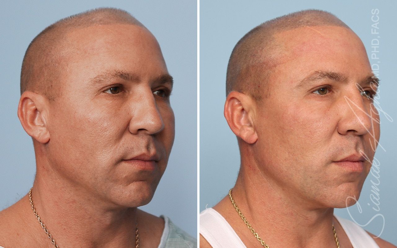 Ellacor Before & After