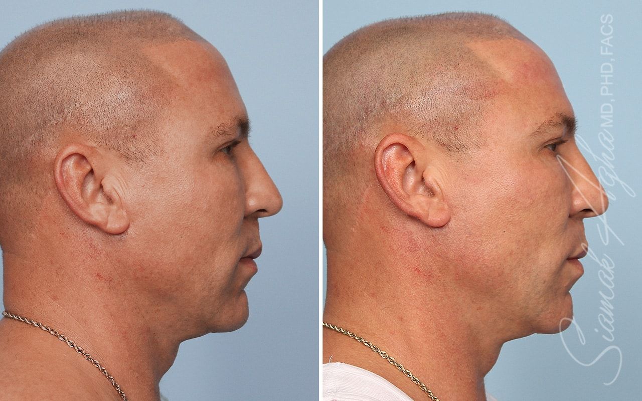 Ellacor Before & After