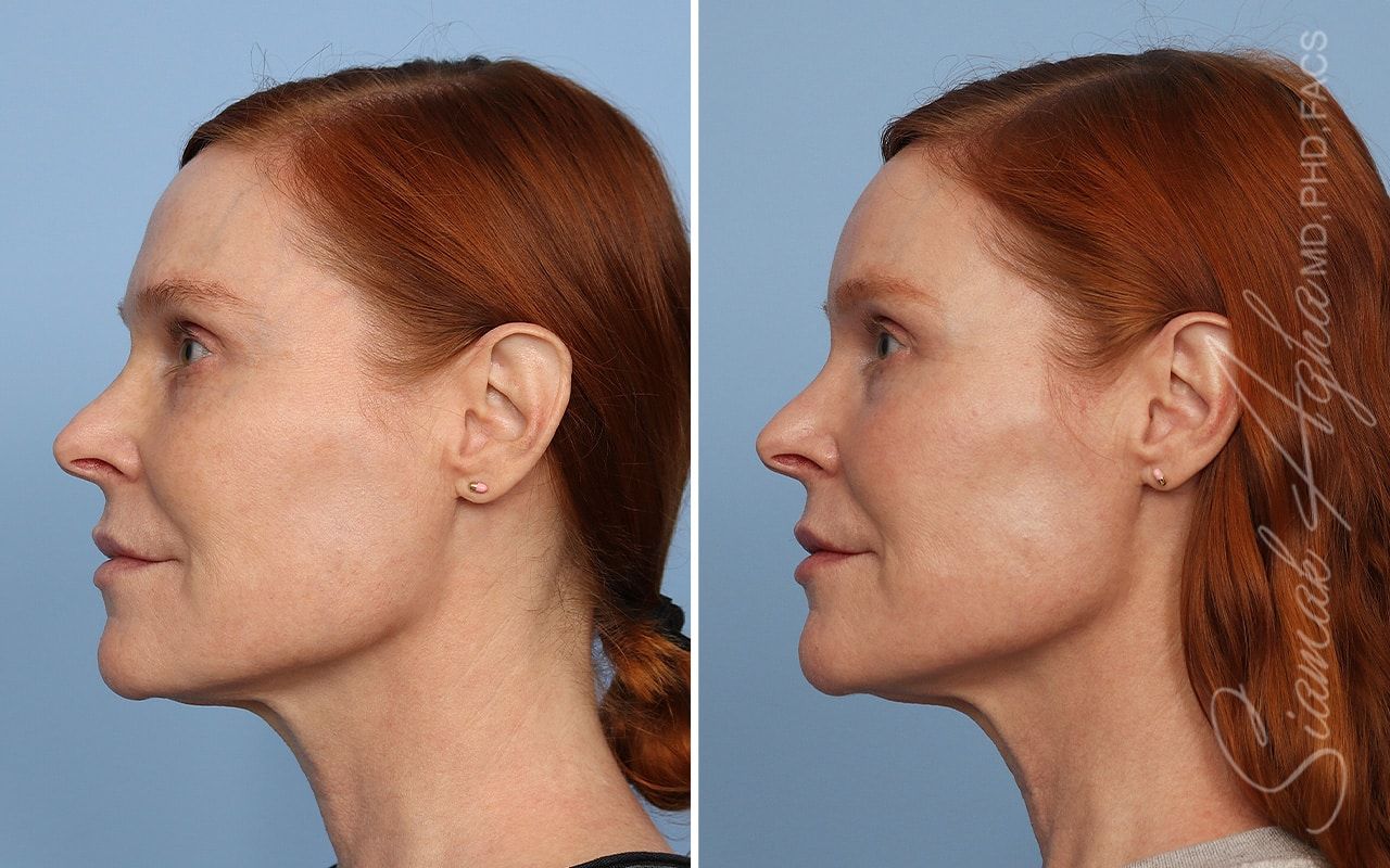 Ellacor Before & After