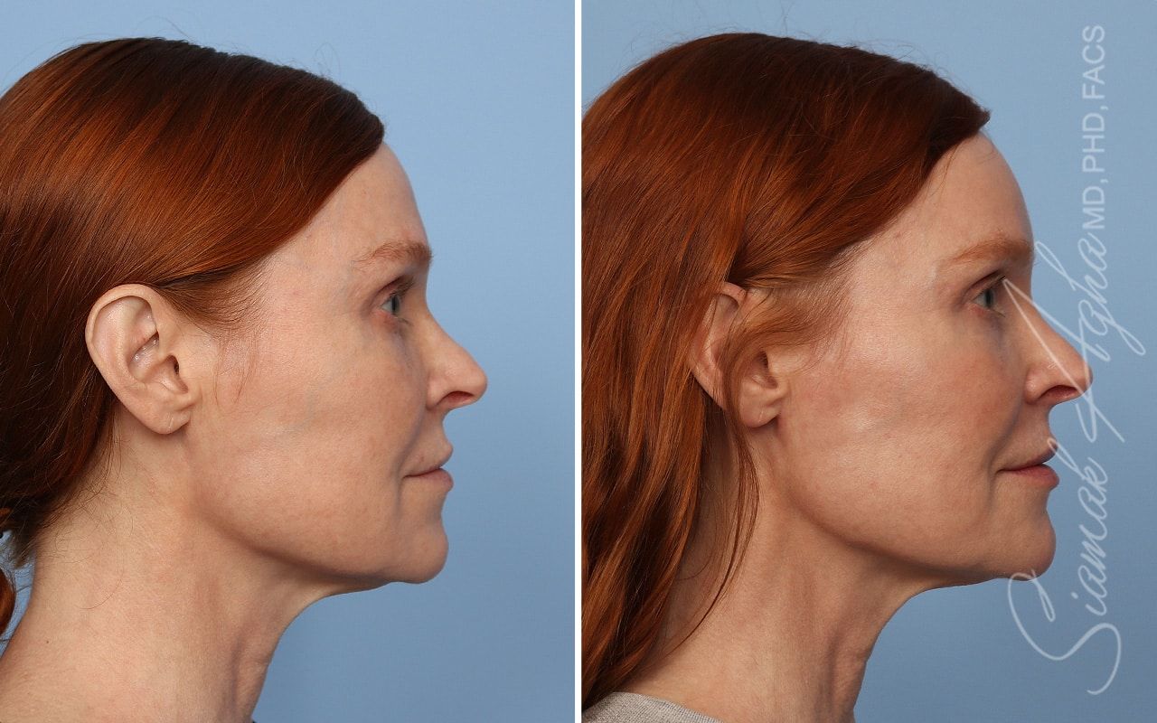 Ellacor Before & After