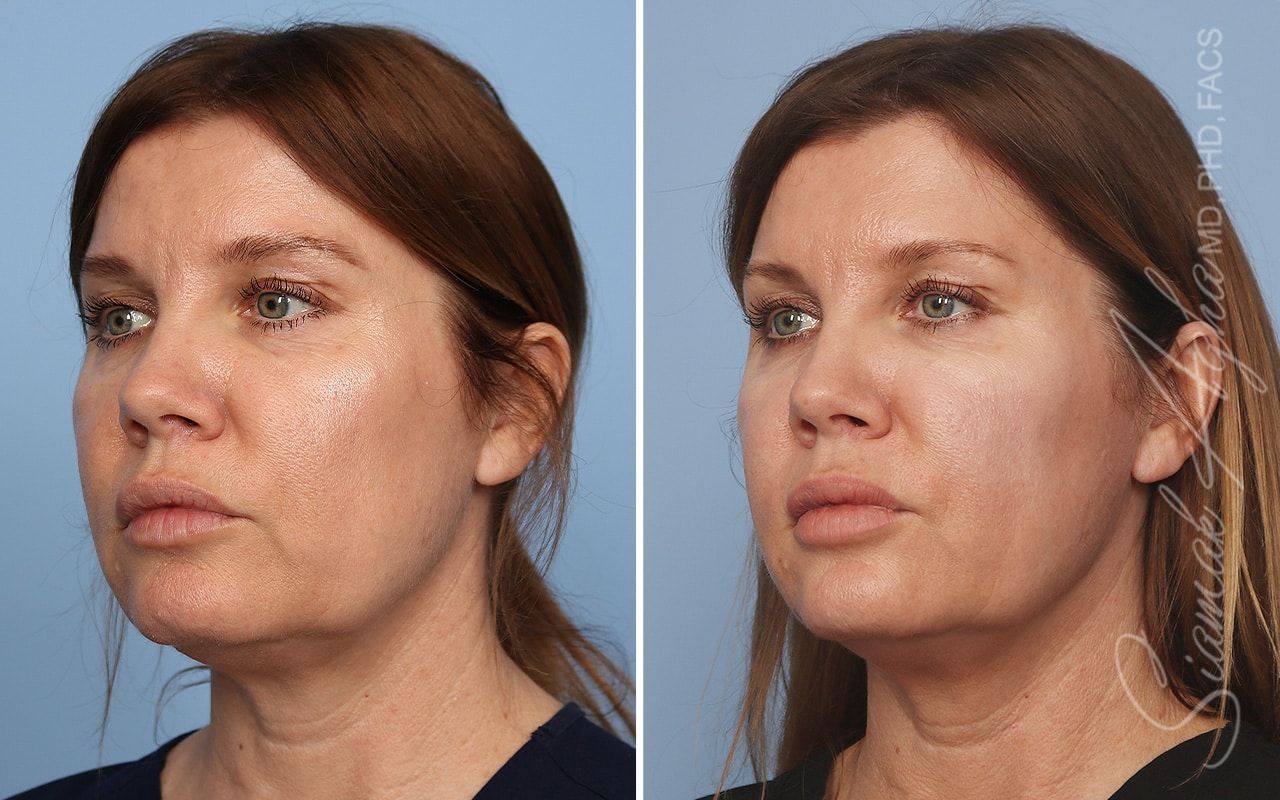 Ellacor Before & After