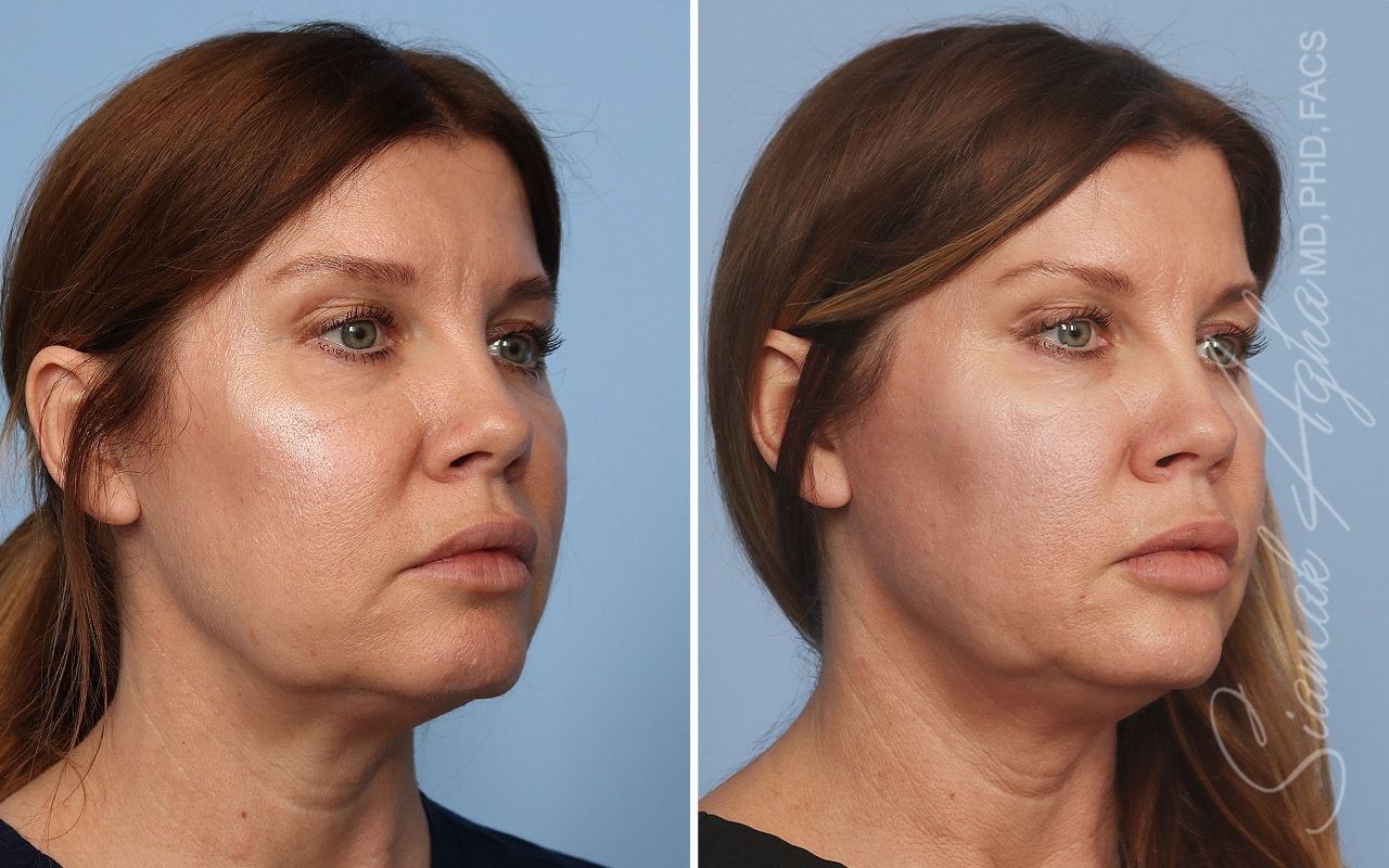 Ellacor Before & After