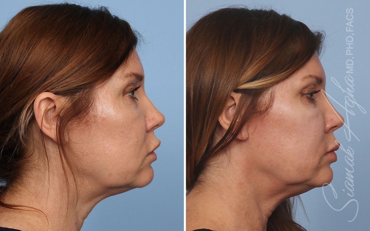 Ellacor Before & After