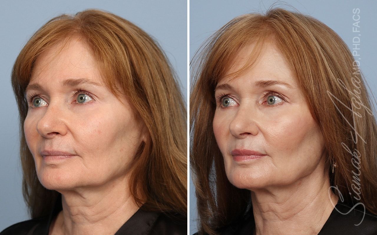 Ellacor Before & After