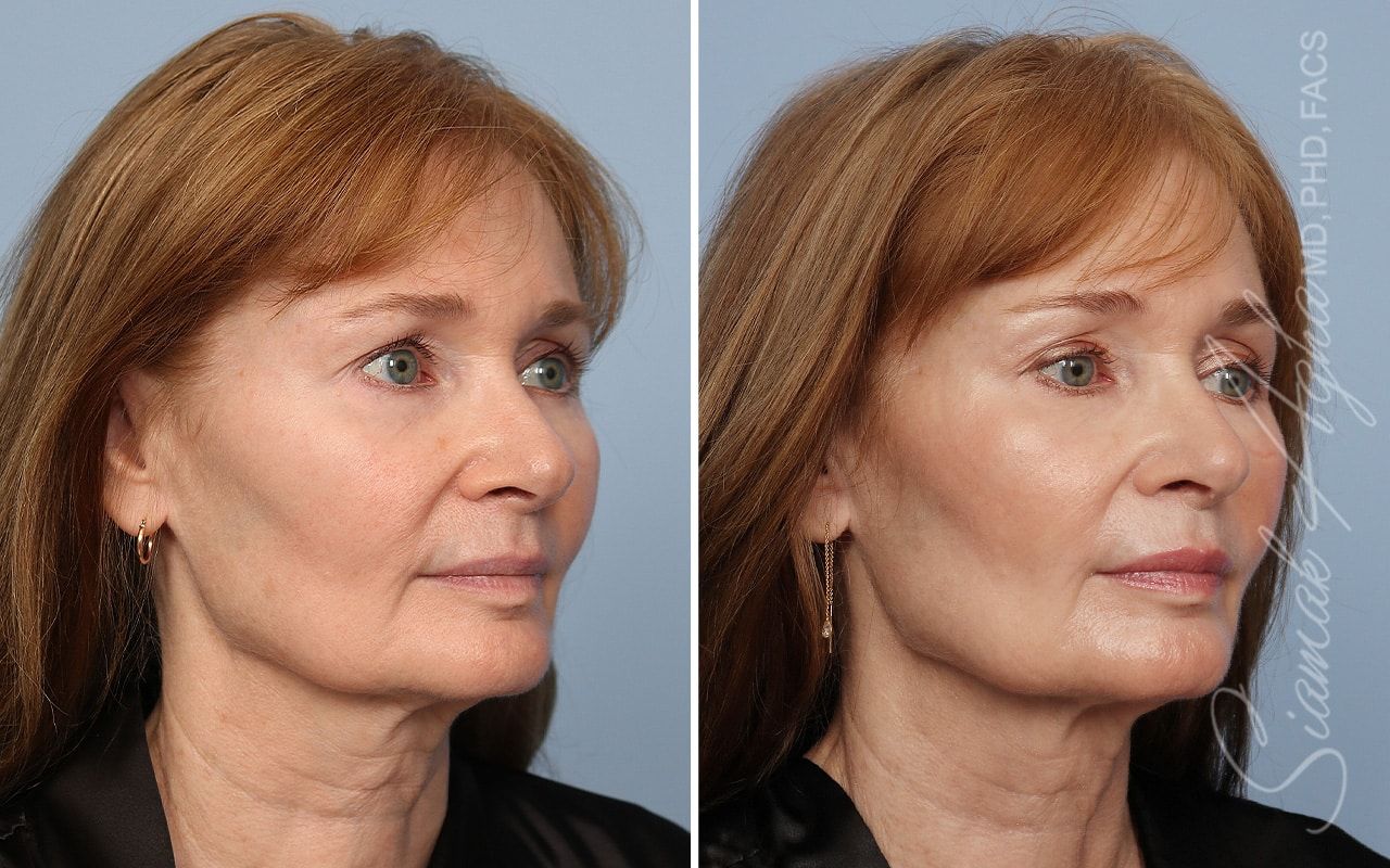 Ellacor Before & After