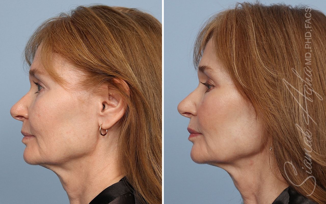 Ellacor Before & After