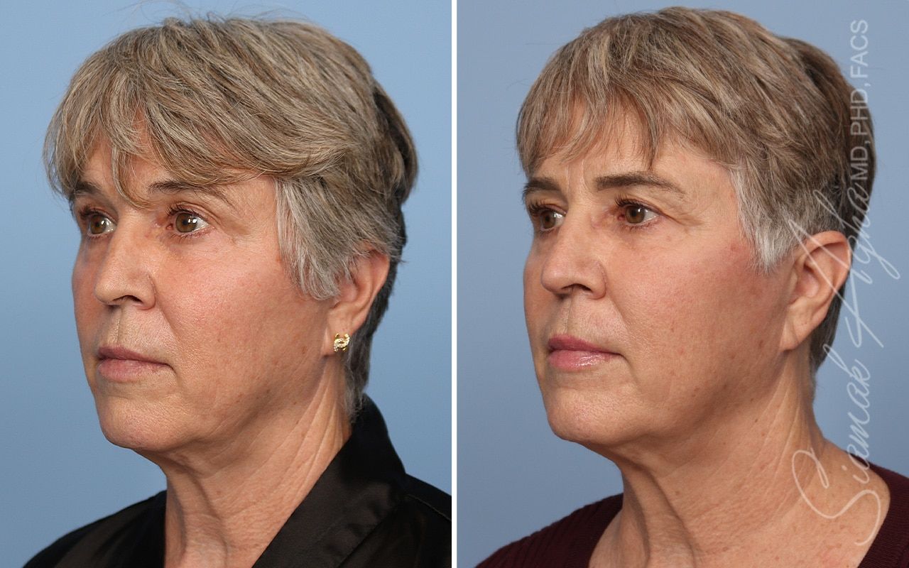 Ellacor Before & After