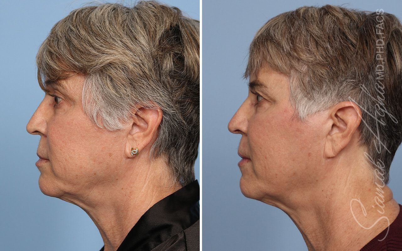 Ellacor Before & After