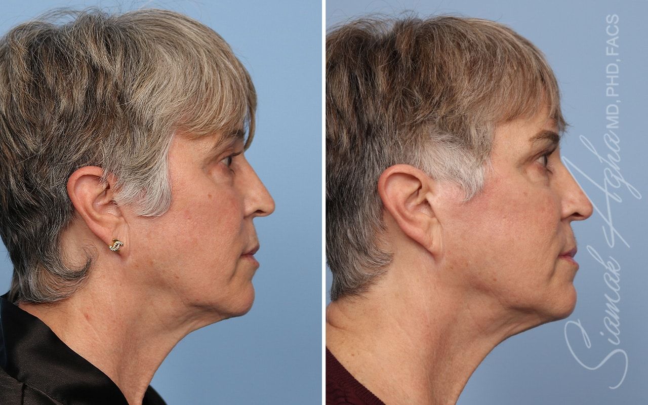 Ellacor Before & After