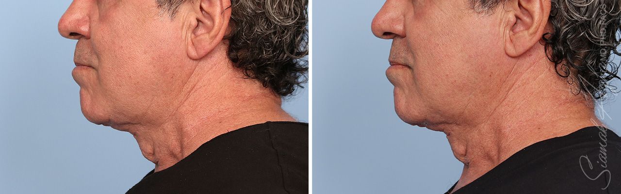 Ellacor Before & After