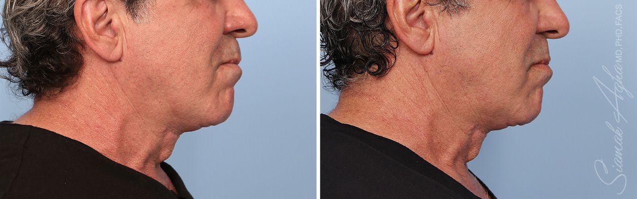 Ellacor Before & After