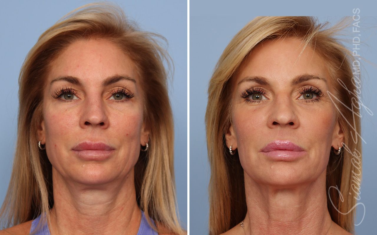 Ellacor Before & After