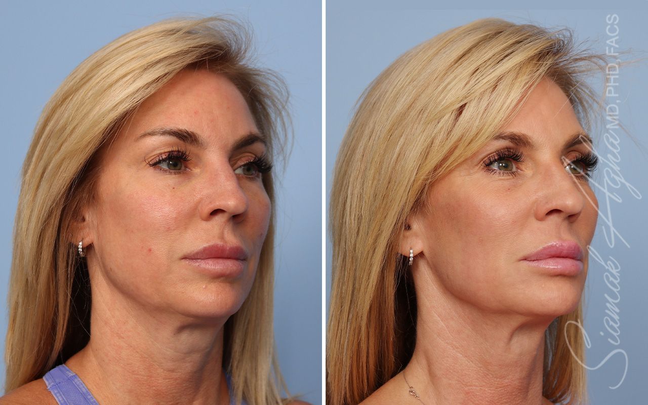 Ellacor Before & After