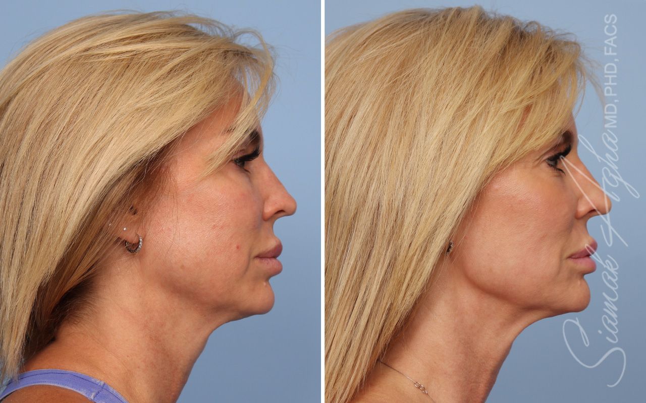 Ellacor Before & After