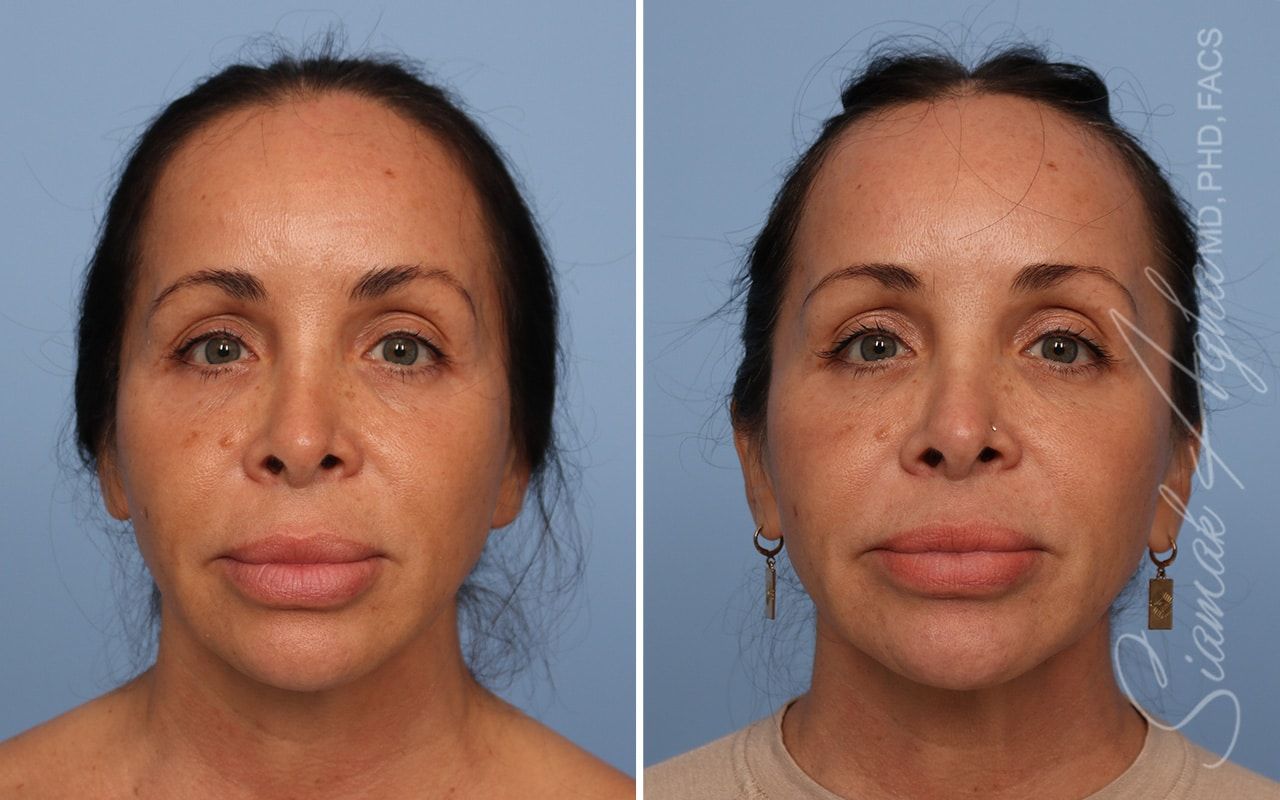 Ellacor Before & After