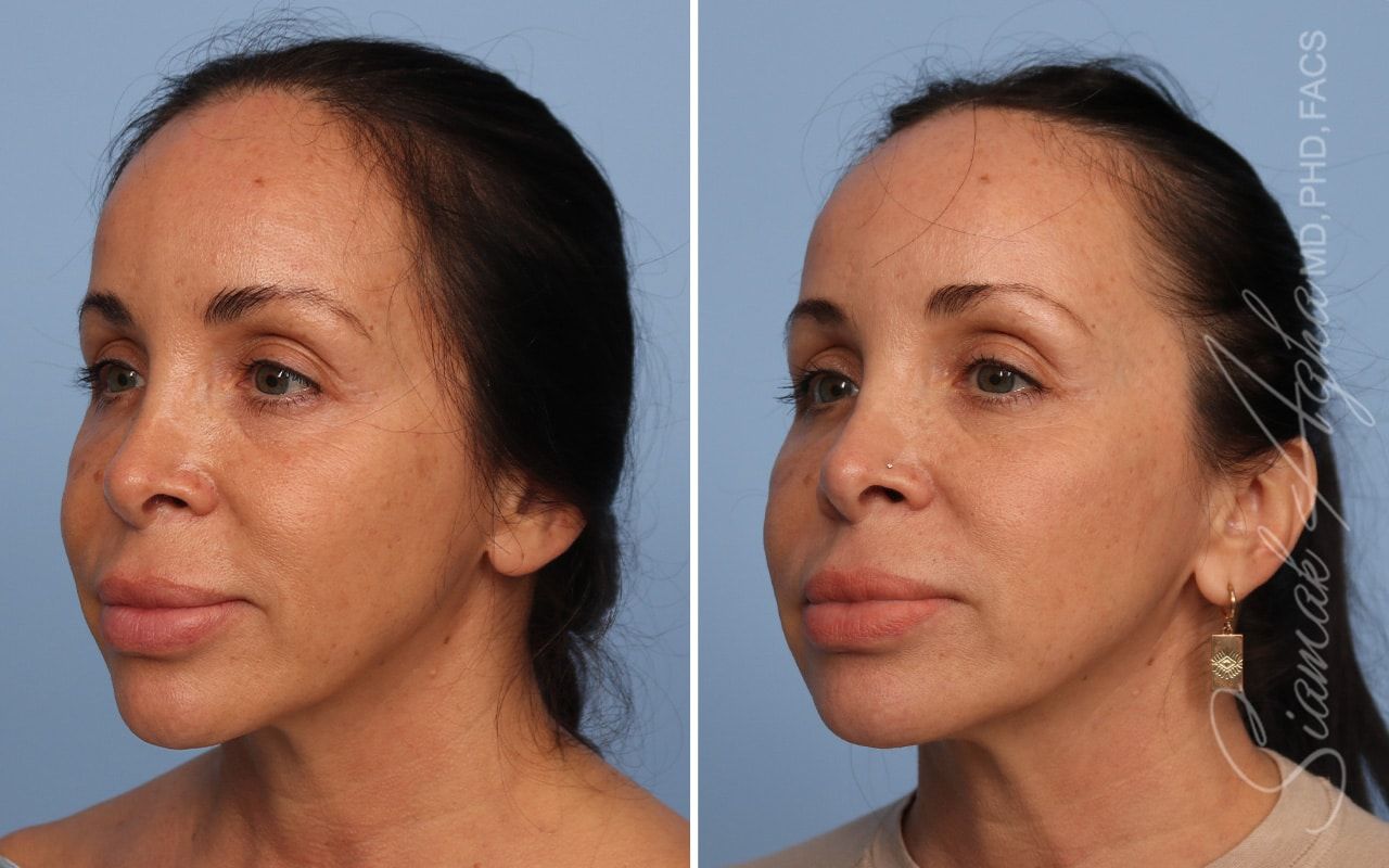 Ellacor Before & After