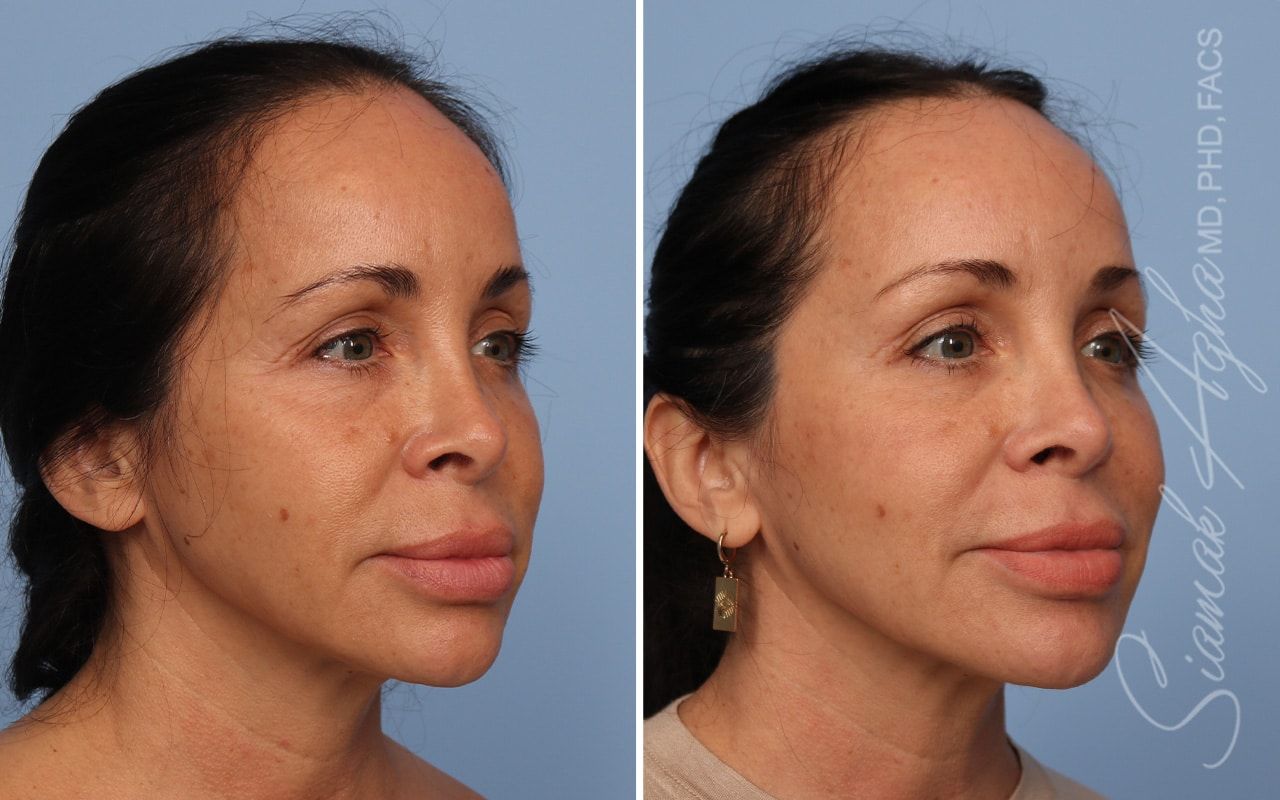 Ellacor Before & After