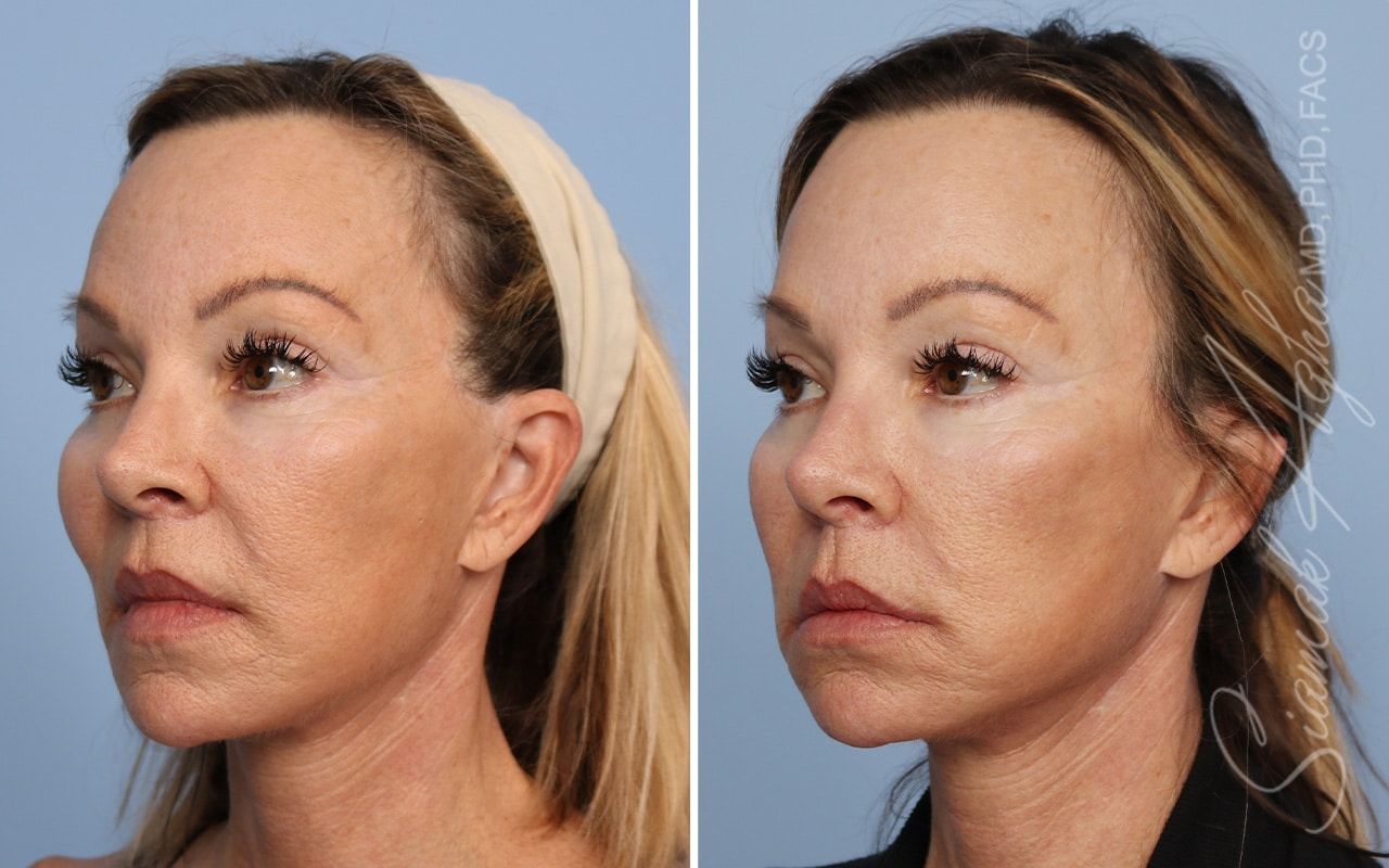 Ellacor Before & After