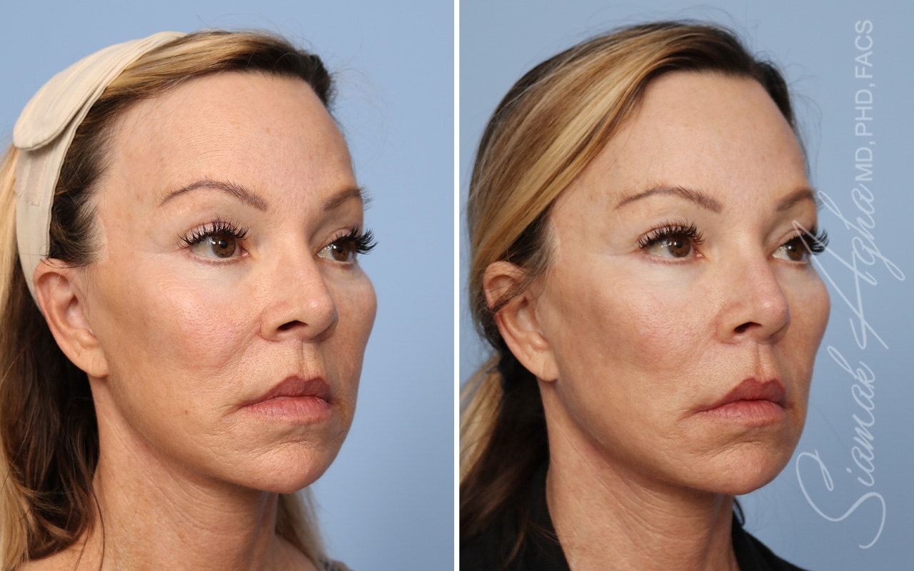 Ellacor Before & After