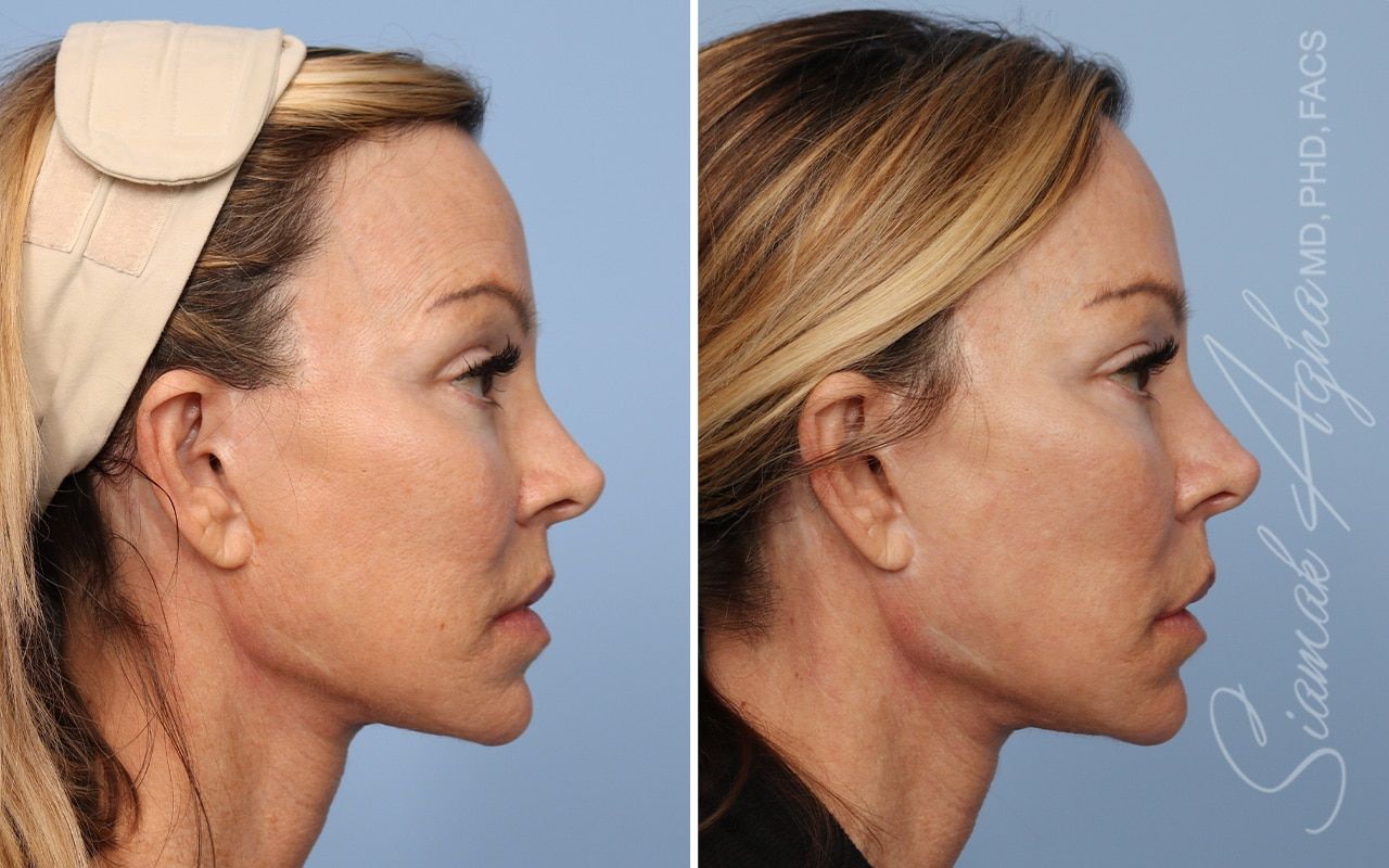 Ellacor Before & After