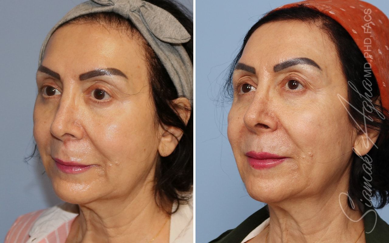 Ellacor Before & After