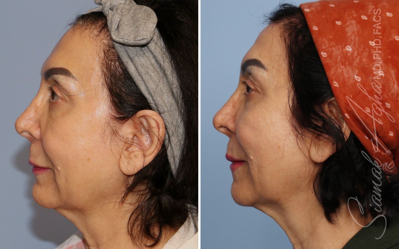 Ellacor Before & After