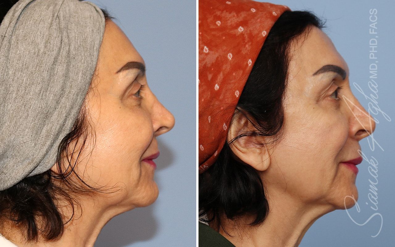 Ellacor Before & After