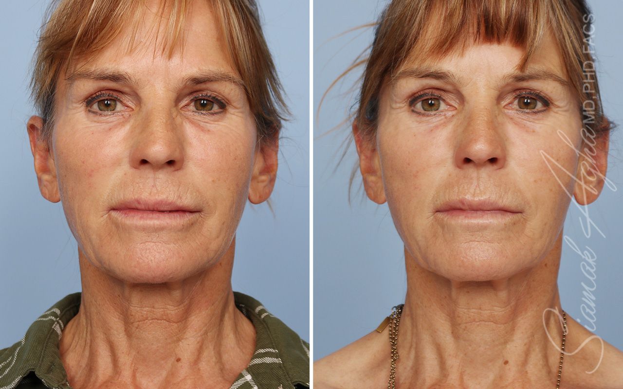 Ellacor Before & After