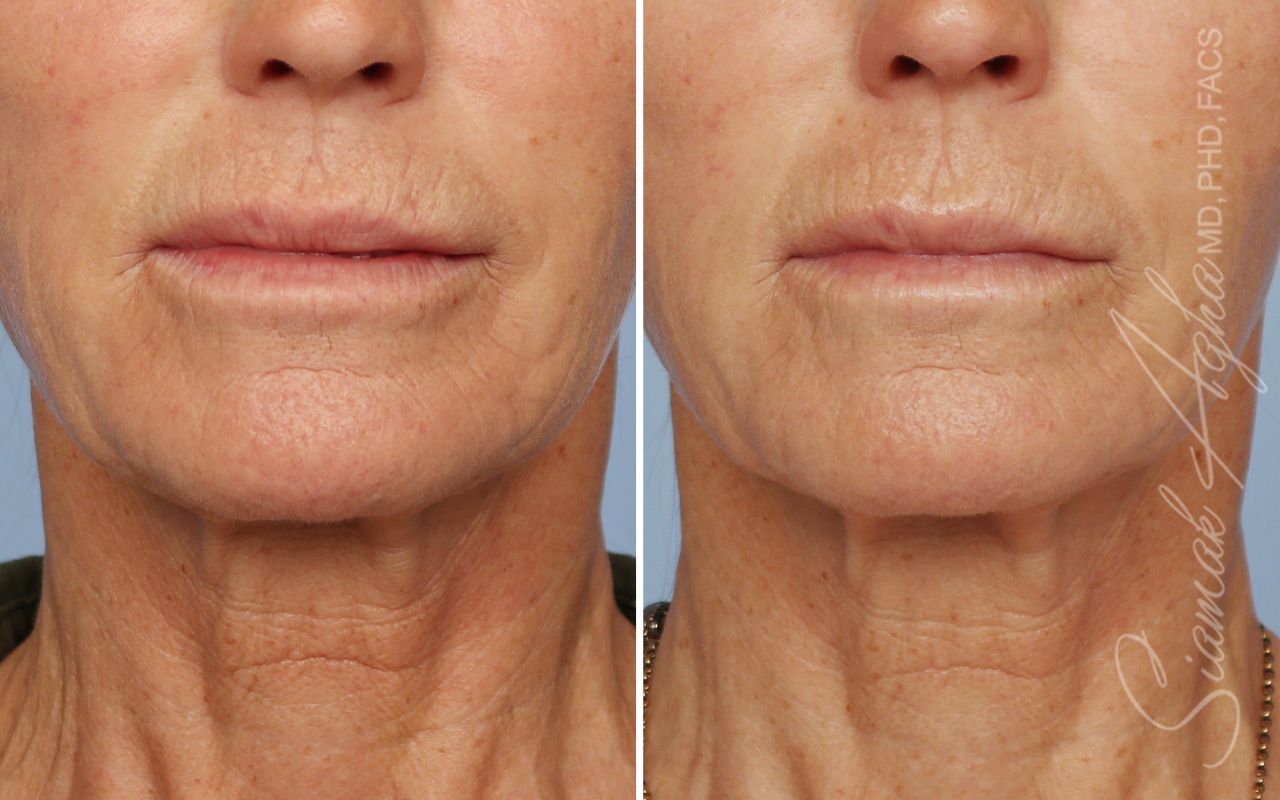 Ellacor Before & After