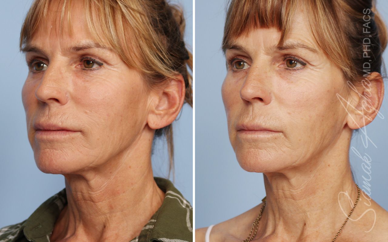 Ellacor Before & After