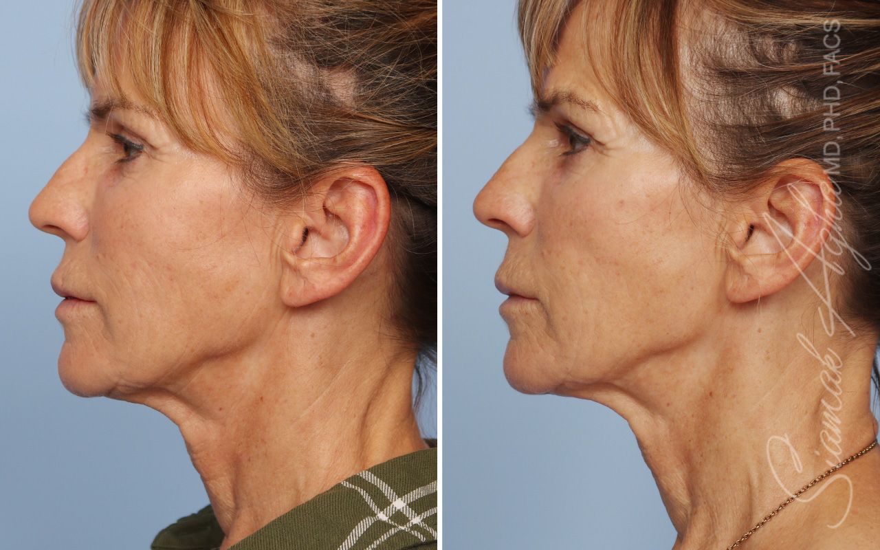 Ellacor Before & After