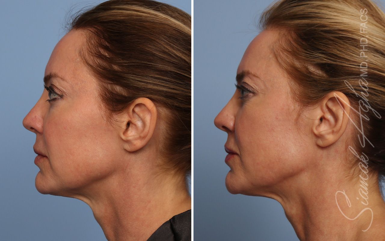 Ellacor Before & After