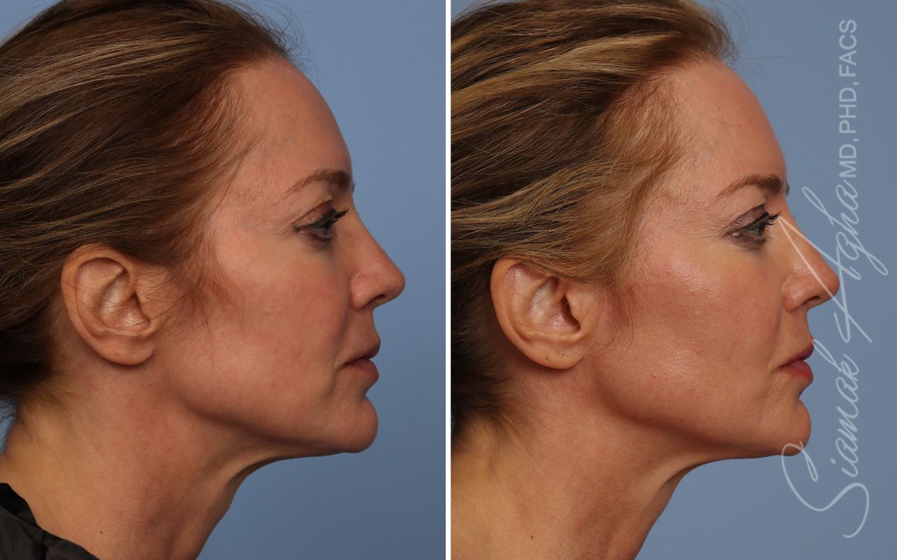 Ellacor Before & After