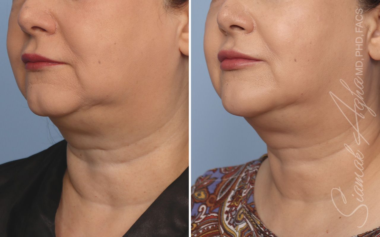 Ellacor Before & After