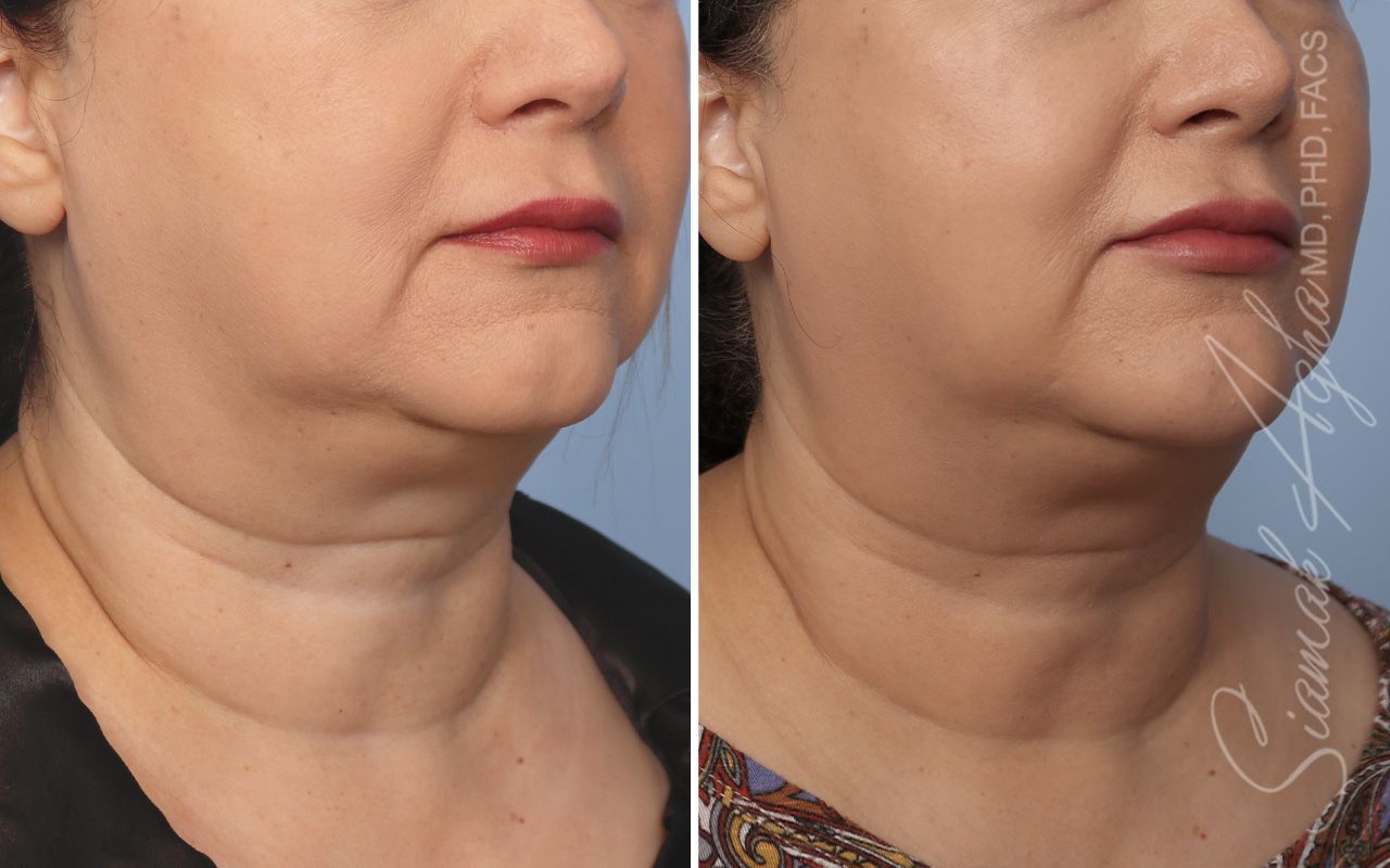 Ellacor Before & After